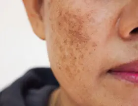 Melasma, Dark Spots